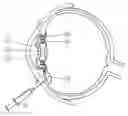 Fig. 01 - Accommodative lens implant, controlled by the ciliary muscle