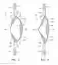 Fig. 04 - Hydrolic accommodating intraocular lens