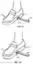 Fig. 03 - Step over walking aid