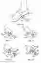 Fig. 28 - Step over walking aid