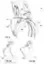 Fig. 07 - Splitter grappler