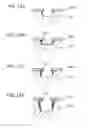 Fig. 10 - Plasma etching method