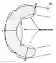 Fig. 01 - Polymeric stent having modified molecular structures in selected regions of the hoops and method for making the same