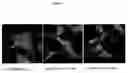 Fig. 03 - Methods for reducing intimal hyperplasia, smooth muscle cell proliferation and restenosis in mammals