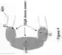 Fig. 05 - Polymeric stent having modified molecular structures in selected regions of the flexible connectors