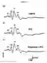 Fig. 02 - Utilization of vinpocetine to avoid complications in particular those associated to hearing which occur with epilepsy, and treatment thereof