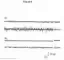 Fig. 07 - Utilization of vinpocetine to avoid complications in particular those associated to hearing which occur with epilepsy, and treatment thereof