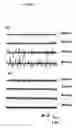 Fig. 08 - Utilization of vinpocetine to avoid complications in particular those associated to hearing which occur with epilepsy, and treatment thereof