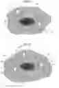 Fig. 06 - Lifting method for lesion area, and anchoring device