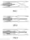 Fig. 02 - Catheter system and method for fine navigation in a vascular system