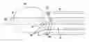 Fig. 01 - Directional needle injection drug delivery device and method use