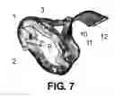 Fig. 06 - BLOOD PRESSURE CUFF WITH CYLINDRICAL BLADDER