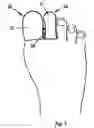Fig. 06 - Toe glove device