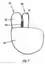Fig. 08 - Toe glove device
