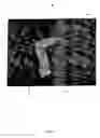 Fig. 02 - Device and method for rapid aspiration and collection of body tissue from within an enclosed body space