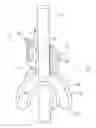 Fig. 04 - Endoscopic device stabilizer