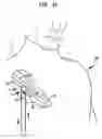 Fig. 03 - Implantable dialysis access port
