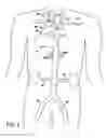 Fig. 02 - Partial aortic occlusion devices and methods for cerebral perfusion augmentation