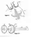Fig. 06 - Method and apparatus for applying medication to internal tissue