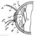 Fig. 01 - Device and method for reshaping the cornea