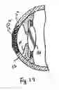 Fig. 09 - Device and method for reshaping the cornea