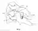 Fig. 07 - Facet spacer