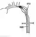 Fig. 01 - Aligning device for stent graft delivery system