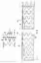 Fig. 04 - Aligning device for stent graft delivery system