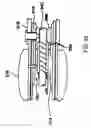 Fig. 12 - Aligning device for stent graft delivery system
