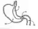 Fig. 01 - Pyloric valve corking device