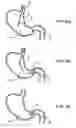 Fig. 08 - Pyloric valve corking device