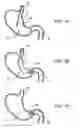 Fig. 09 - Pyloric valve corking device