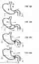 Fig. 10 - Pyloric valve corking device