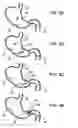 Fig. 11 - Pyloric valve corking device