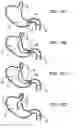 Fig. 12 - Pyloric valve corking device