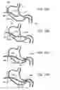 Fig. 15 - Pyloric valve corking device