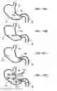 Fig. 16 - Pyloric valve corking device