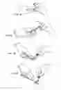 Fig. 03 - Safety suture needle assemblies and methods