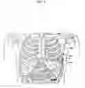 Fig. 03 - Subcutaneous defibrillation system and method using same