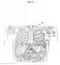 Fig. 04 - Subcutaneous defibrillation system and method using same