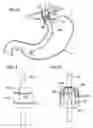 Fig. 11 - Bulimia treatment