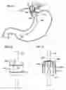 Fig. 11 - GI inflammatory disease treatment