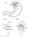 Fig. 11 - Pancreatitis treatment