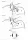 Fig. 12 - Pancreatitis treatment
