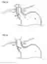 Fig. 13 - Pancreatitis treatment
