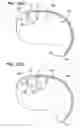 Fig. 16 - Method of intravascularly delivering stimulation leads into brain to stimulate the SPG