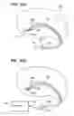 Fig. 22 - Method of intravascularly delivering stimulation leads into brain to stimulate the SPG