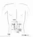 Fig. 10 - Methods and apparatus for thermally-induced renal neuromodulation