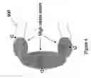 Fig. 05 - Polymeric stent having modified molecular structures in the flexible connectors and in the radial struts and the radial arcs of the hoops