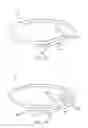 Fig. 16 - Telescoping bifurcated stent